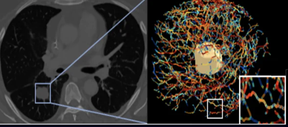 Picture Health and Image Analysis Group (IAG) Announce Strategic Partnership to Advance AI-Driven  Imaging Endpoints in Oncology Clinical Trials