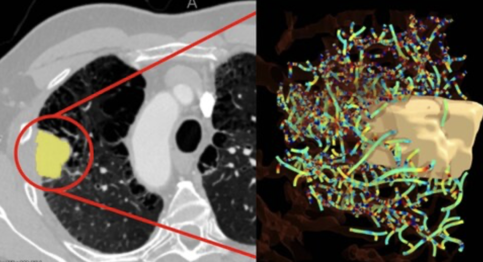 New AI Solution Helps Predict Which Lung Cancer Patients Will Benefit from Immunotherapy